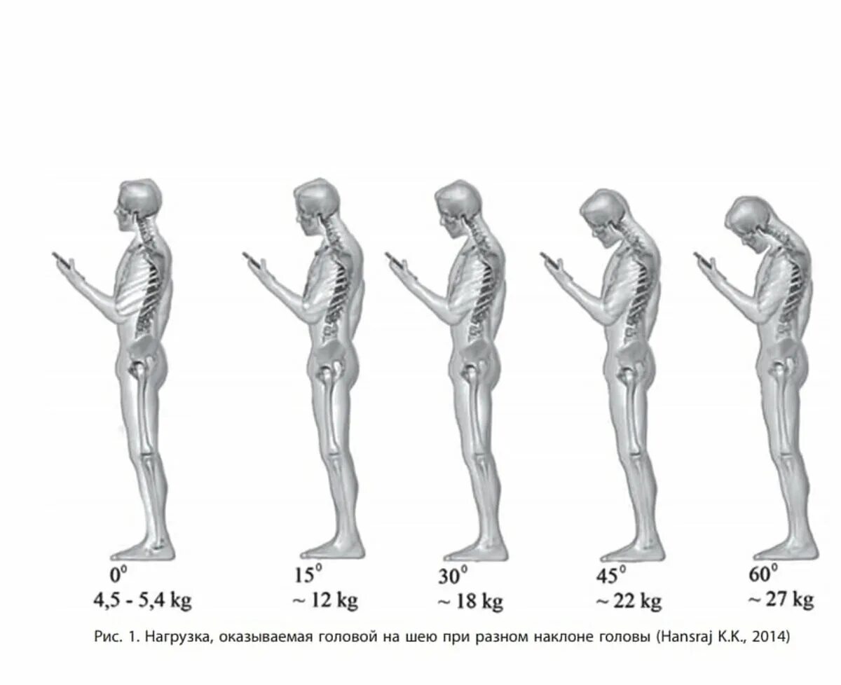 Нагрузка на позвоночник в зависимости от наклона головы. Нагрузка на шею при наклоне головы. Вес головы при наклоне. Нагрузка на шейный отдел.