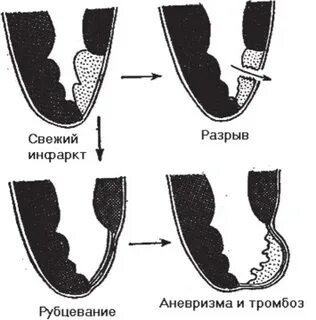 Исходы инфаркта