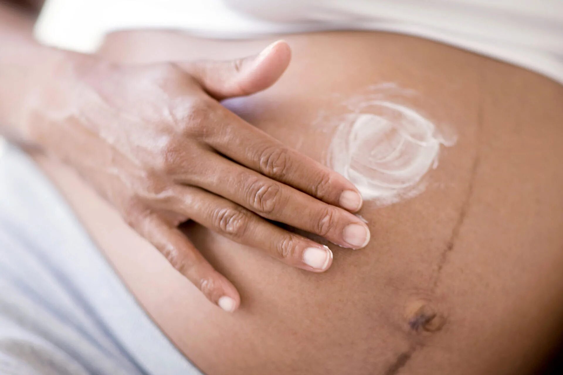 Во время беременности появляется. Пигментация беременных. Пигментация беременных на животе. Живот беременной с растяжками.