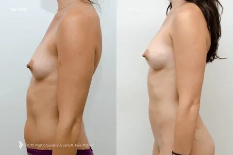 Fat Transfer Breast Augmentation.