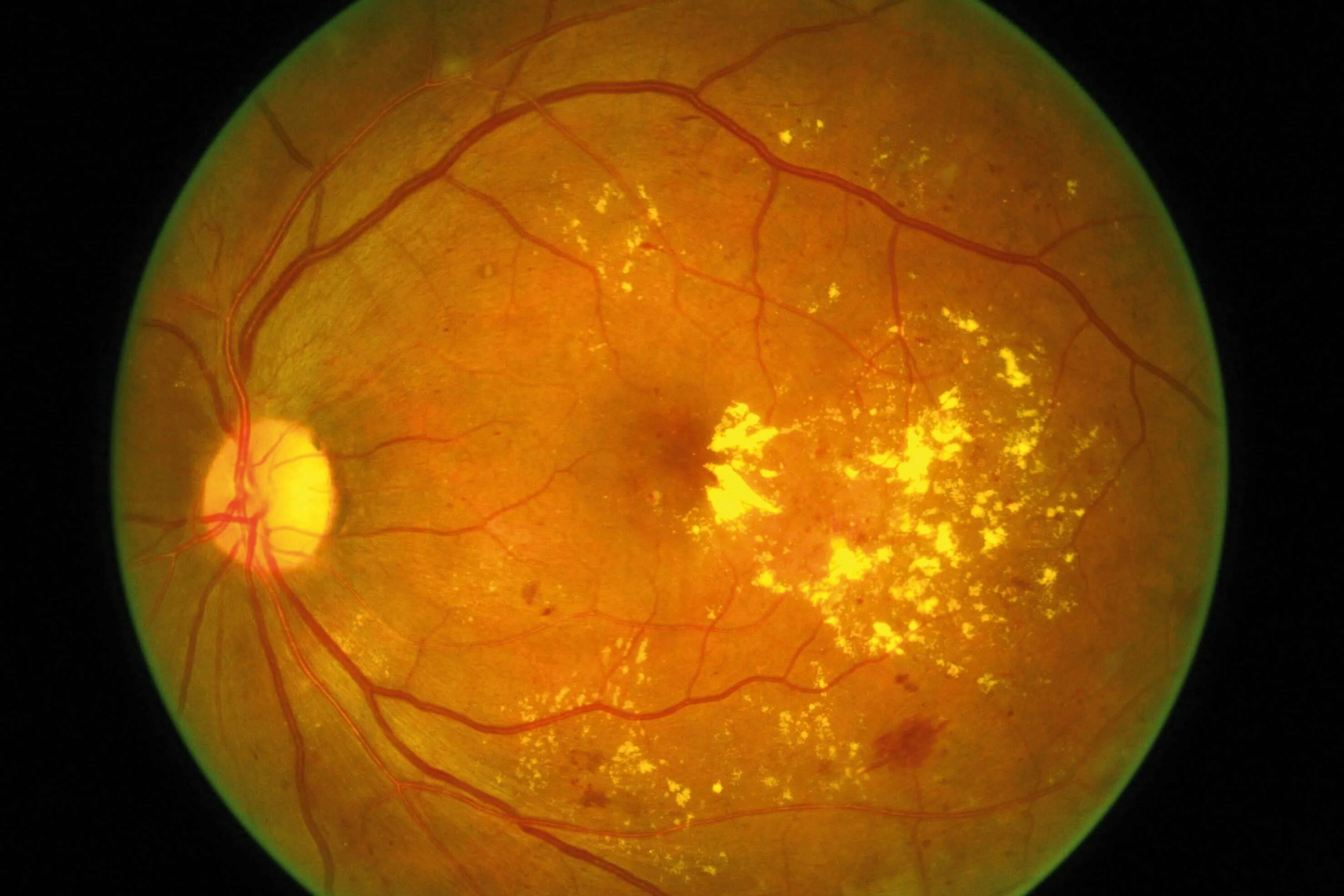 Почечная гипертоническая ретинопатия. Гипертоническая ретинопатия офтальмология. Макулярная дистрофия сетчатки. Ou гипертоническая ангиопатия сетчатки.