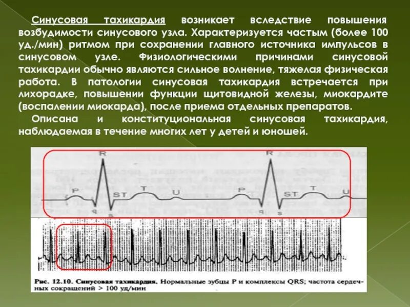 Синусовая тахикардия вертикальное. Синусовая тахикардия. Синусовая тахикардия возникает при. При синусовой тахикардии :. Для синусовой тахикардии характерно.