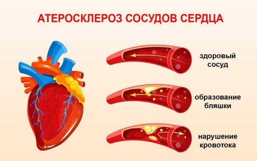 Ишемическая болезнь сосудов. Атеросклероз венечных сосудов. Атеросклеротическое поражение коронарных артерий. Атеросклероз сосудов ишемическая болезнь. Атеросклероз венечных сосудов сердца симптомы.