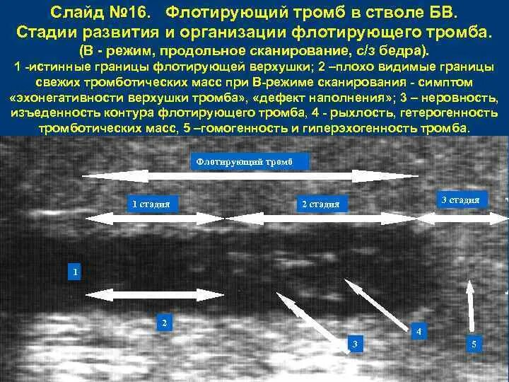Описание тромба. Флотирующий тромб в бедренной Вене. Флотирующий тромб признаки. Признаки флотирующего тромба УЗИ.