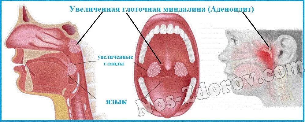 Как лечить аденоиды. Аденоиды носоглоточные миндалины. аденоиды это разрастание лимфоидной ткани. глоточная миндалина аденоиды. разрастание носоглоточной миндалины.