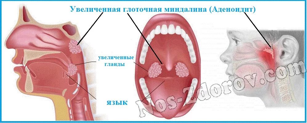 Аденоиды носоглоточные миндалины. Глоточная миндалина аденоиды. Гипертрофия носоглоточной миндалины (аденоиды).