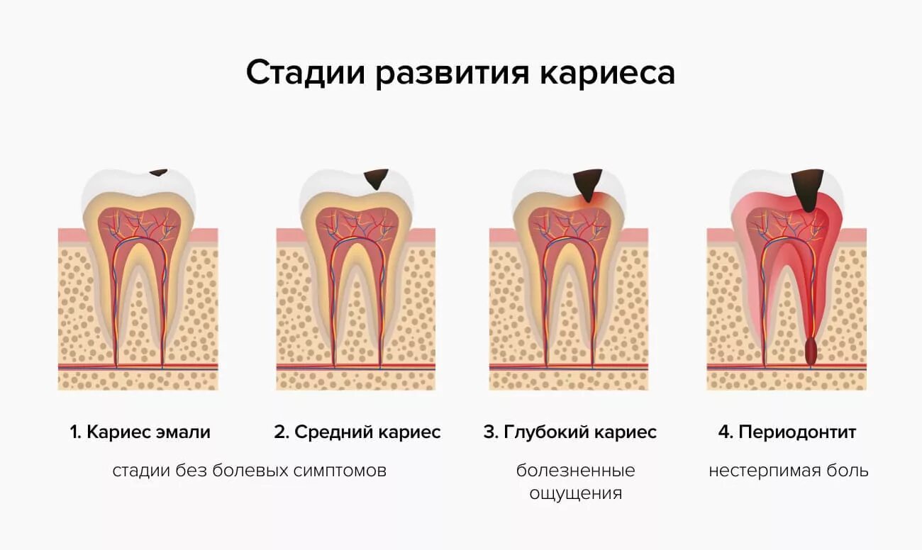 Через 1 стадии. Степени развития кариеса. Кариес дентина глубокий кариес. Схема развития кариеса зубов. Симптомы кариеса стадии развития.