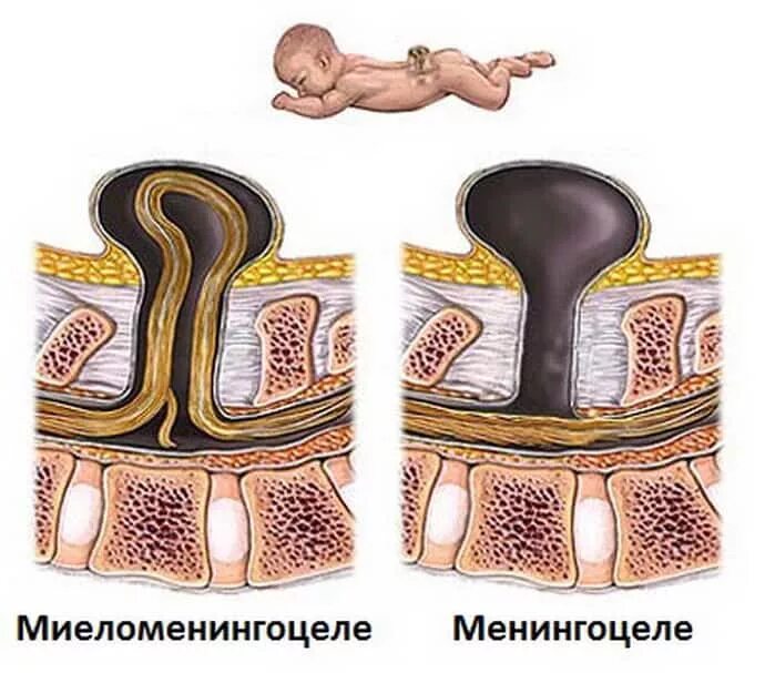 Спинномозговая грыжа