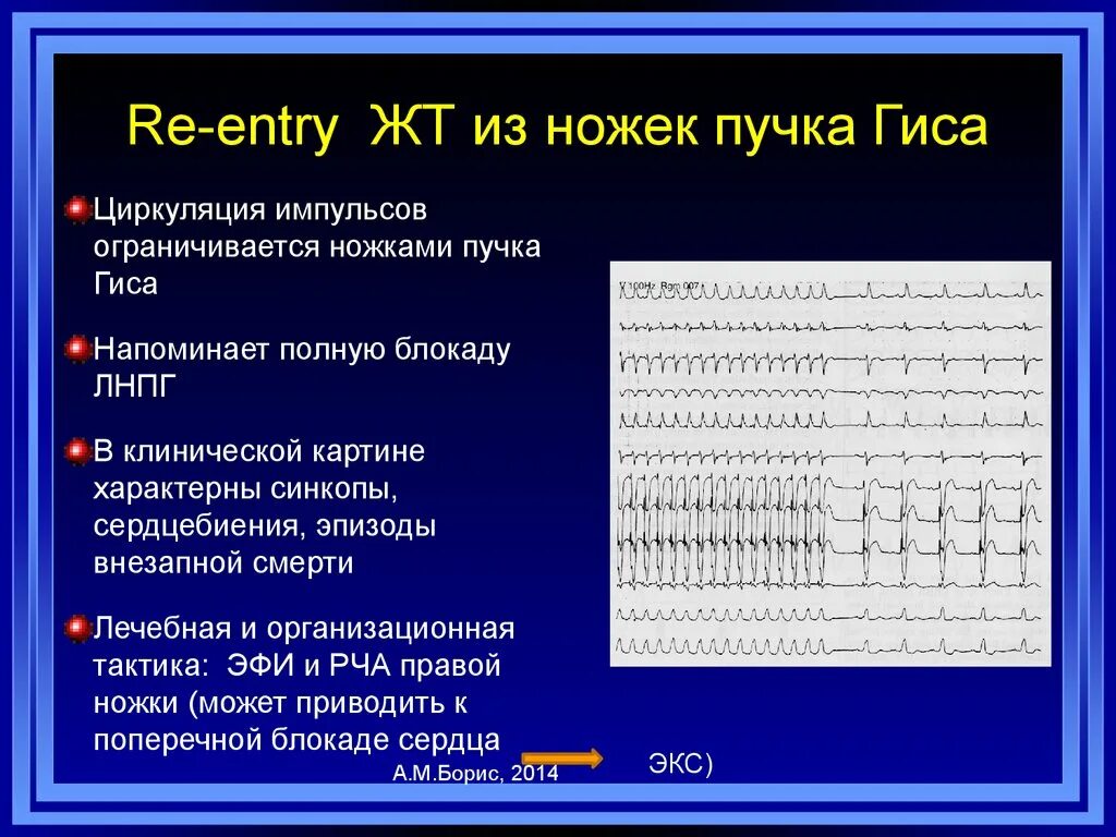 Разветвление верхней левой ножки пучка гиса. Желудочковая тахикардия по типу блокады правой ножки пучка Гиса. Фибрилляция предсердий с блокадой правой ножки пучка Гиса. Мерцательная аритмия на фоне блокады левой ножки пучка Гиса на ЭКГ. ЭКГ фибрилляция предсердий блокада правой пучка Гиса.