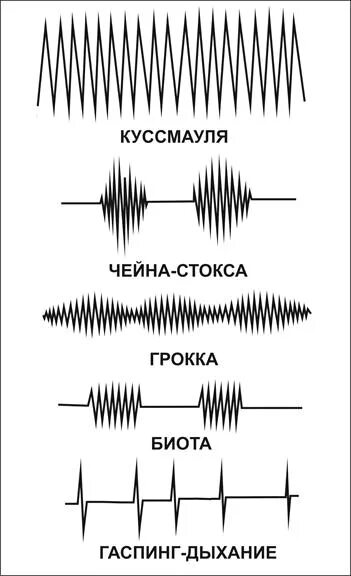 Патологическое дыхание чейна стокса. Типы дыхания куссмауля чейна стокса биота. Типы дыхания куссмауля чейна стокса биота. Патологическое дыхание чейна стокса. Типы дыхания чейна стокса куссмауля.