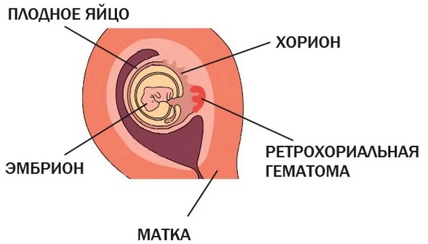 Отслойка хориона на ранних сроках. Гематома при беременности на ранних сроках. Ретрохориальная гематома беременность. Гематома на плодном яйце при беременности. Ретрексиальная гематома.