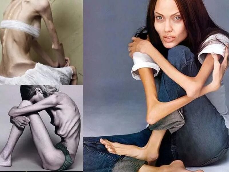 Больно большой худая. Больно большой худая. Рейчел фаррух анорексия 2020. Асорикция. Больно большой худая.