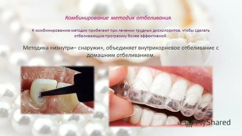 Внутреннее отбеливание. Методика изнутри снаружи отбеливание. внутриканальное отбеливание. отбеливание зуба изнутри. внутрикорневое отбеливание.