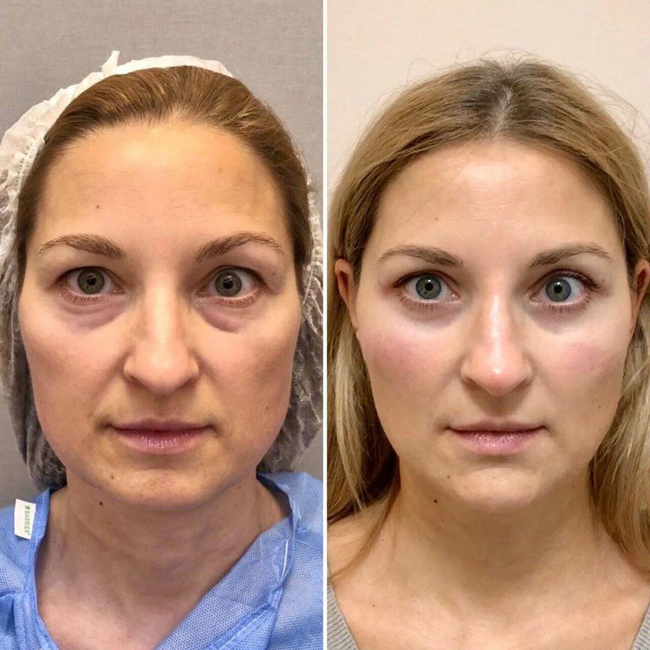 Блефаропластика верхних век санкт-петербург. Нависшее веко блефаропластика. Блефаропластика надежные руки казань. Операция блефаропластика нижних век. Нижняя блефаропластика.