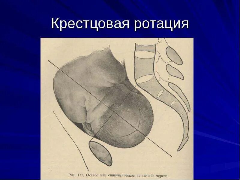 Родовые травмы периферической нервной системы. Ротация головки. Ротация головки. Крестцовая ротация плода. Плечевой сустав суставные движения.