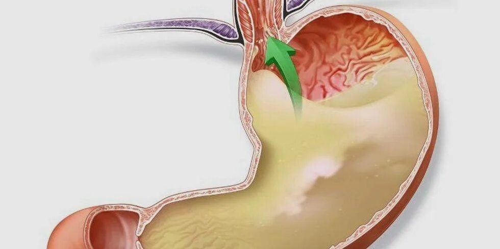 Пищевода тошнота
