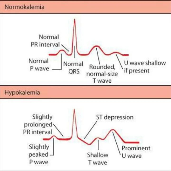 Normal abnormal. Волны normal. hypokalemia. hypokalemia ecg. гипокалиемия на экг.