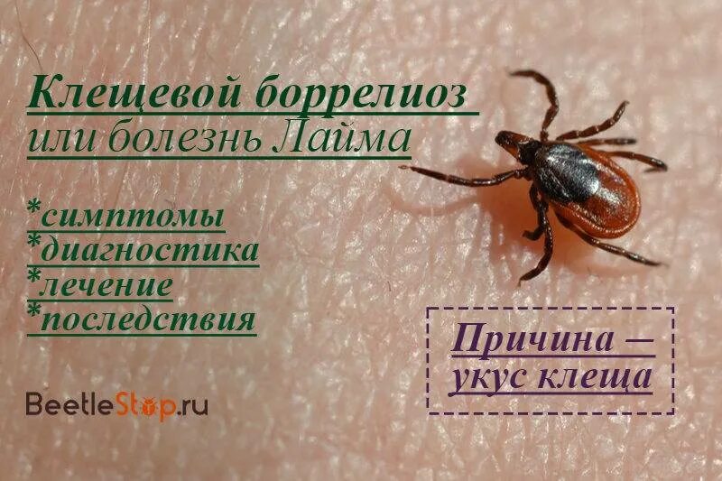 Клещевой боррелиоз симптомы и лечение