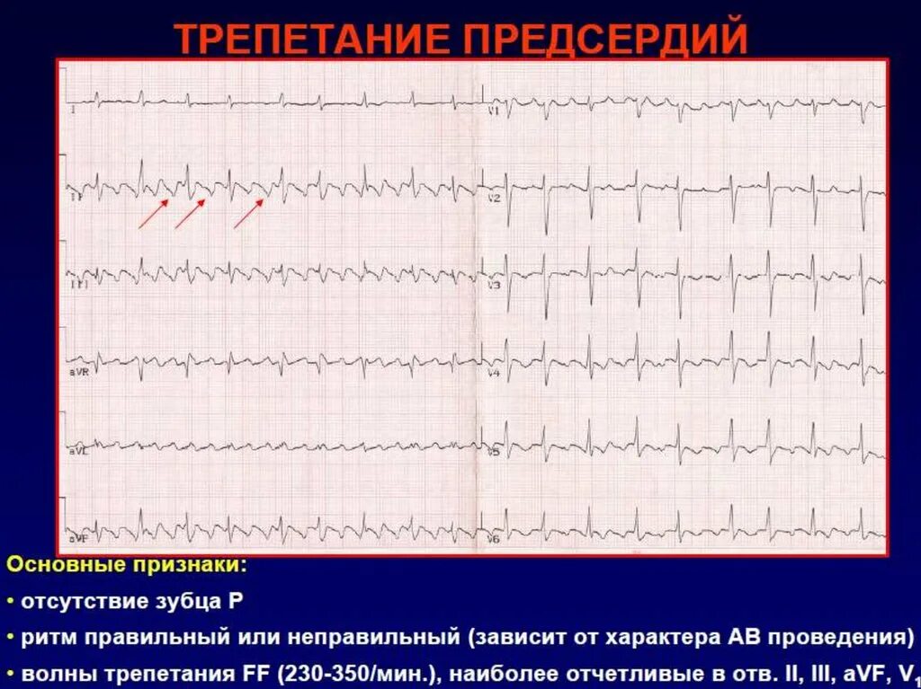 Трепетание предсердий 2 1. Трепетание предсердий 1 к 1 на экг. трепетание предсердий на экг признаки. трепетание предсердий 2 к 1 на экг. трепетание предсердий экг тахисистолия.