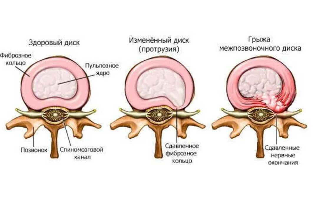 Фиброзное кольцо межпозвоночного диска. Остеохондроз, протрузия, грыжа межпозвоночного диска. Грыжа диска, фиброзное кольцо. Ядро межпозвоночного диска грыжа.