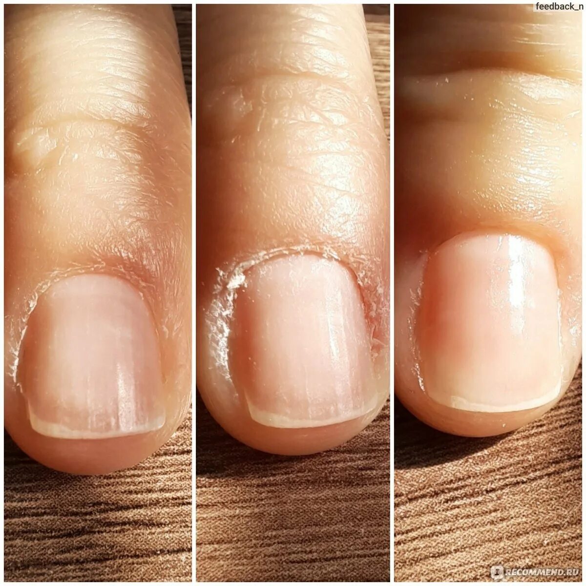 Необработанная кутикула. Классический маникюр. Необработанная кутикула. Маникюр с кутикулой. Срез ногтей.
