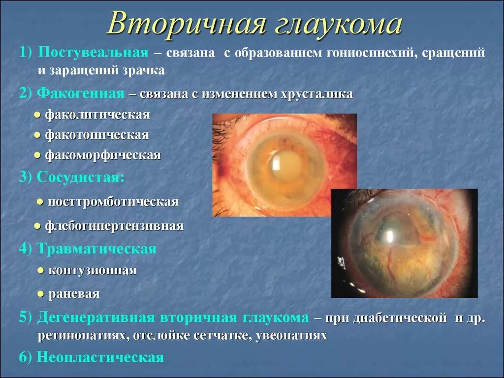Что такое катаракта глаза как лечить. Факолитическая катаракта. вторичная увеальная глаукома. вторичная глаукома причины.
