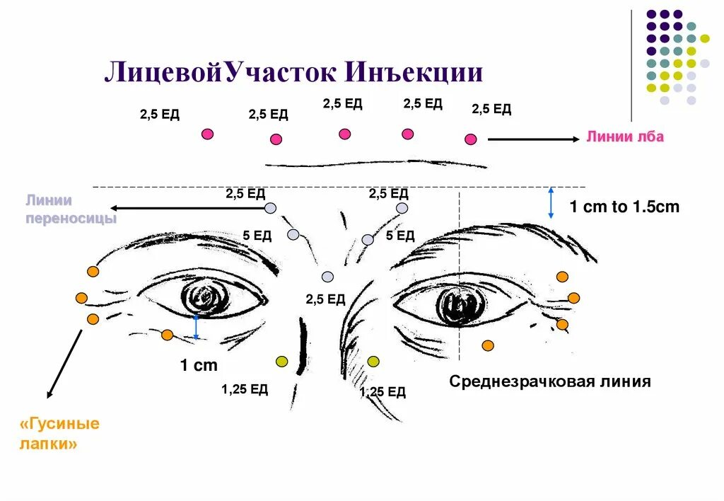 Релатокс лоб сколько. Диспорт схема введения. Точки введения диспорта схема. Схема разведения диспорта 300. Как колоть ботокс схема.