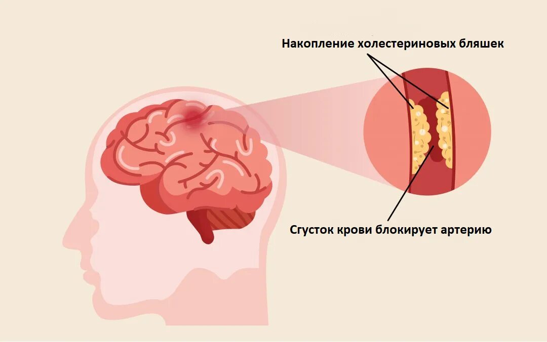 Лечение церебрального атеросклероза сосудов головного. Церебральный атеросклероз. Атеросклероз сосудов головного мозга. Церебральный атеросклероз сосудов головного мозга симптомы. Атеросклероз церебральных артерий.