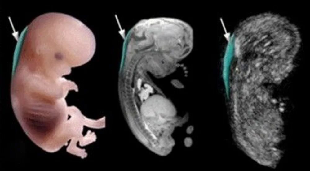 Кистозная гигрома шеи плода. 12 недель беременности узи твп. Кистозная гигрома шеи плода. Гигрома плода 12 недель. Гигрома плода 12 недель.