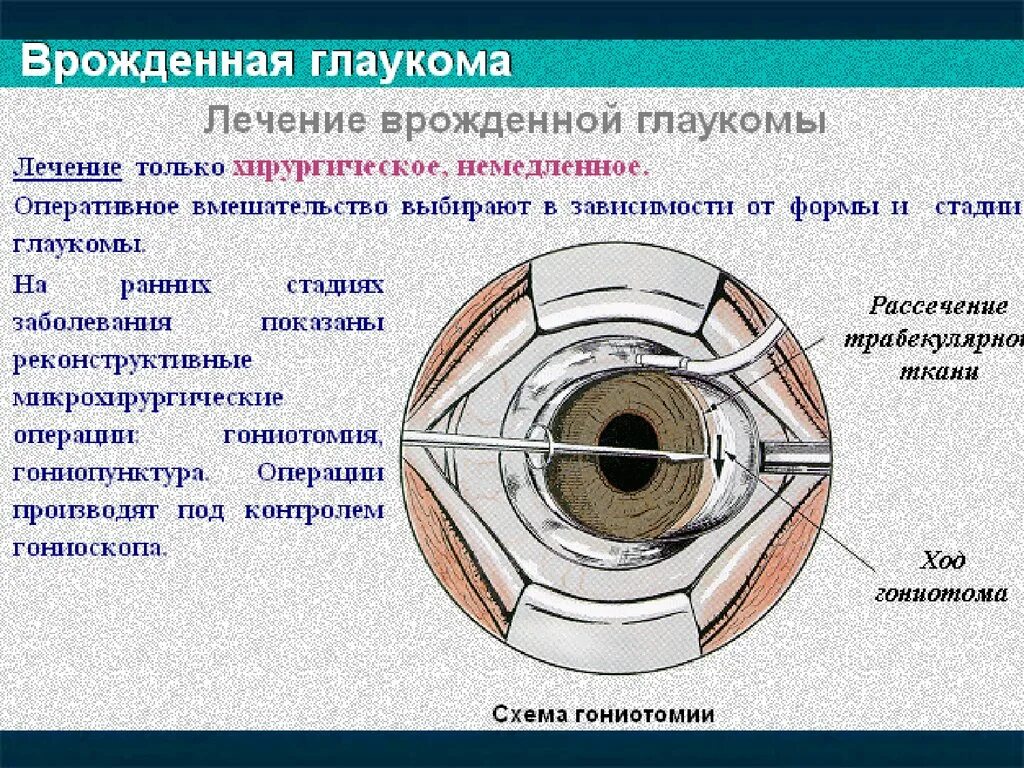 Врожденная глаукома лечение. Врожденная глаукома презентация. Хирургическое лечение врожденной глаукомы. Причины врожденной глаукомы. Глаукома суть операции