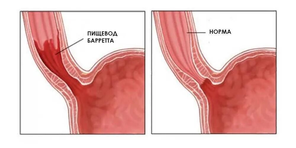 Пищевод барретта что это такое простыми