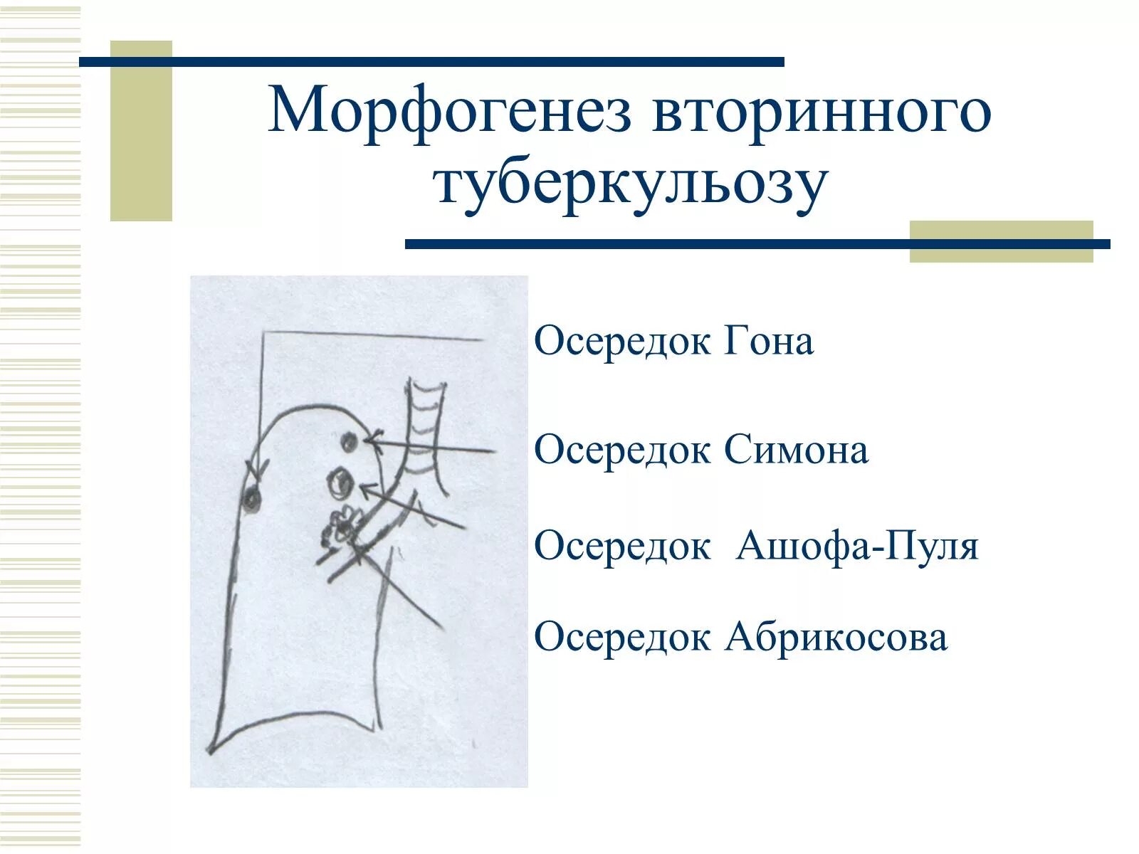 Очаг симон. Очаг симмонда туберкулез.