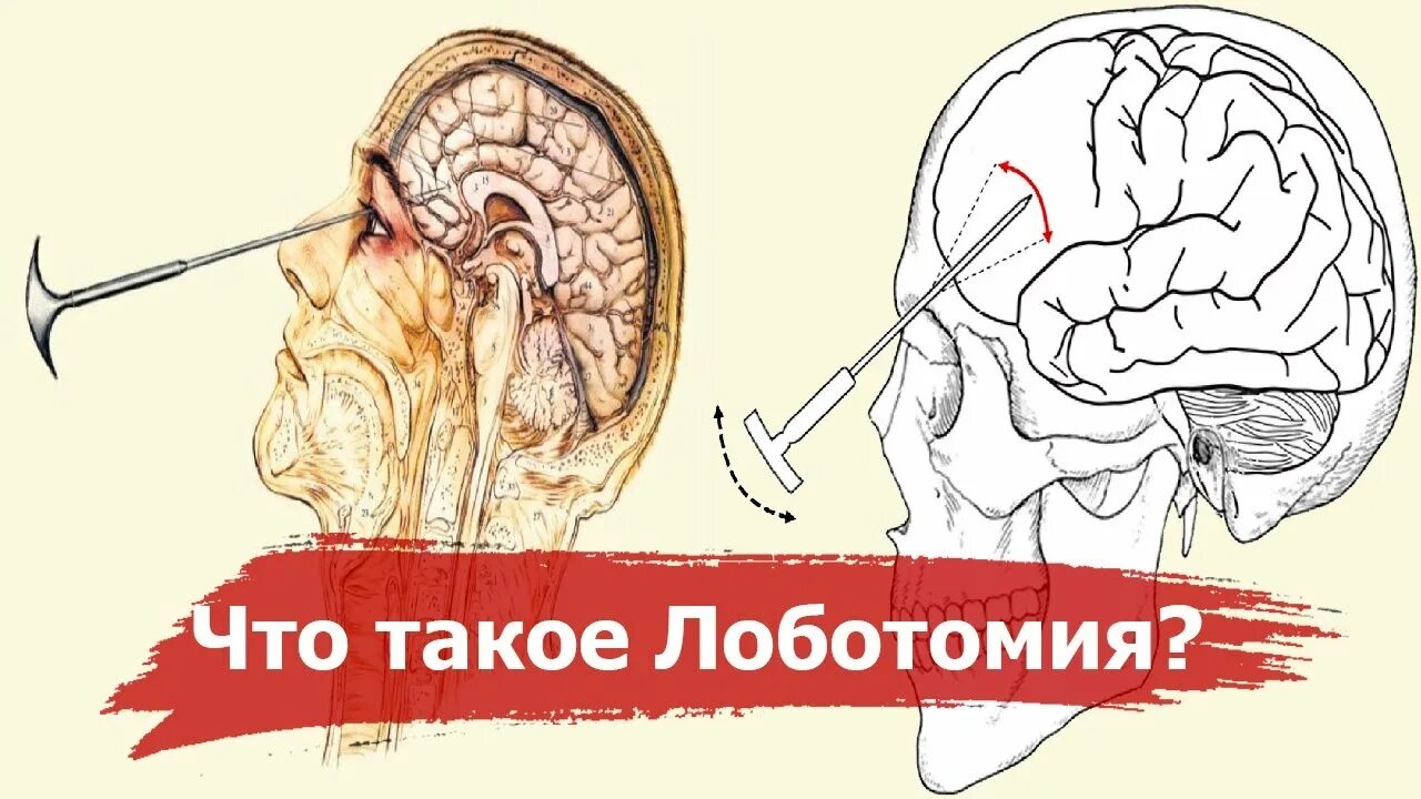 Префронтальная Лоботомия. Трансорбитальная Лоботомия. Орбитокласт Лоботомия.