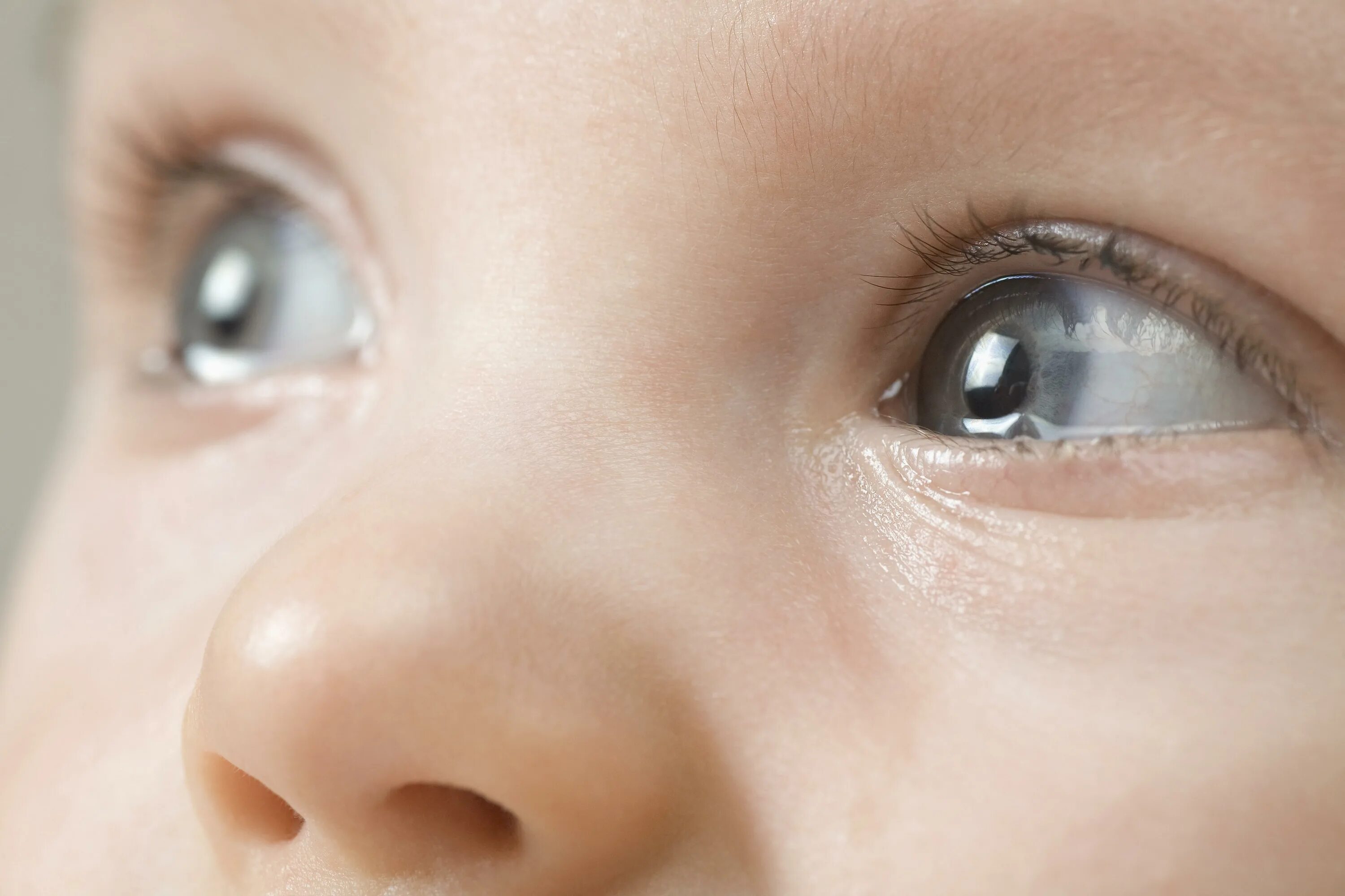 Конъюнктивит ребенка 6 лет. Глаза новорожденного. Конъюнктивит у детей новорожденных. Конъюнктивит у новорожденного ребенка. Конъюнктивит у грудничка.