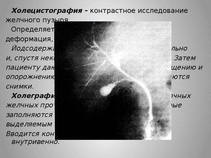 Пероральная холецистография. Холецистография метод исследования. Рентген исследование желчного пузыря. Рентген желчного пузыря и желчных протоков. Рентгенологический метод исследования желчного пузыря.