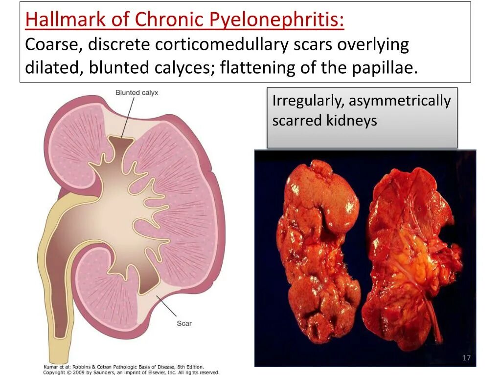 Kidney diseases Pyelonephritis glomerulonephritis treatments рецепт с фото. Пиелит это