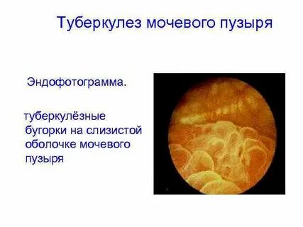 Мочевой туберкулез