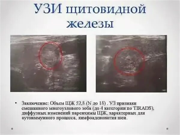 Узловой зоб на узи протокол. Диффузно узловые изменения. Аутоиммунный тиреоидит показатели гормонов щитовидной железы. Диффузно узловые изменения. Диффузно узловые изменения.