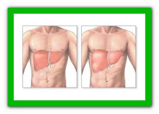 Левая печень увеличена. Увеличенная печень рисунок.