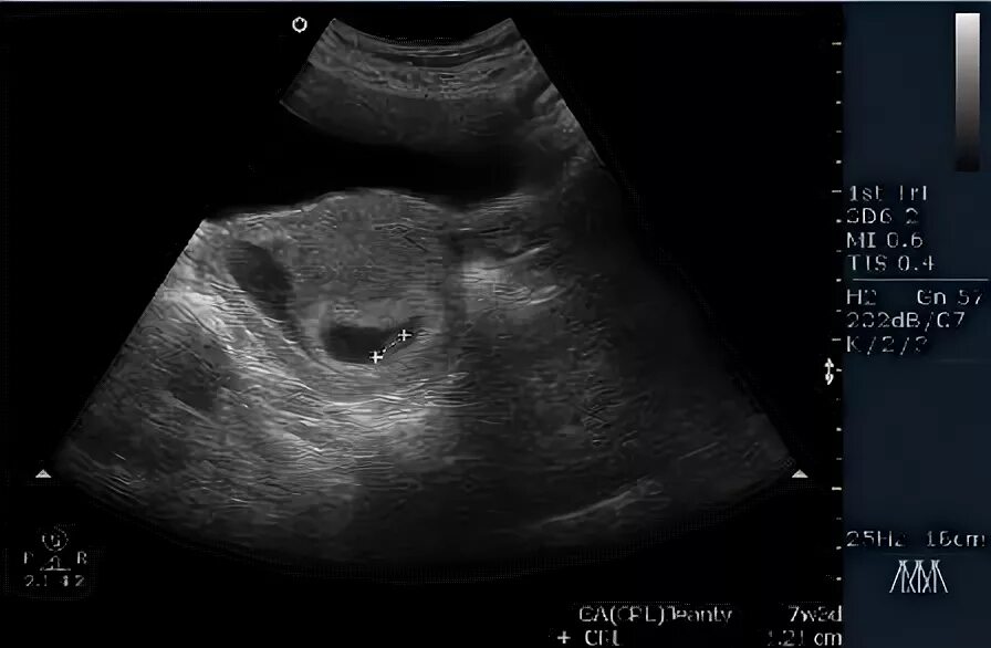 Гематом 7 недель. Субхориальная гематома УЗИ. Ретрохориальная гематома на УЗИ.