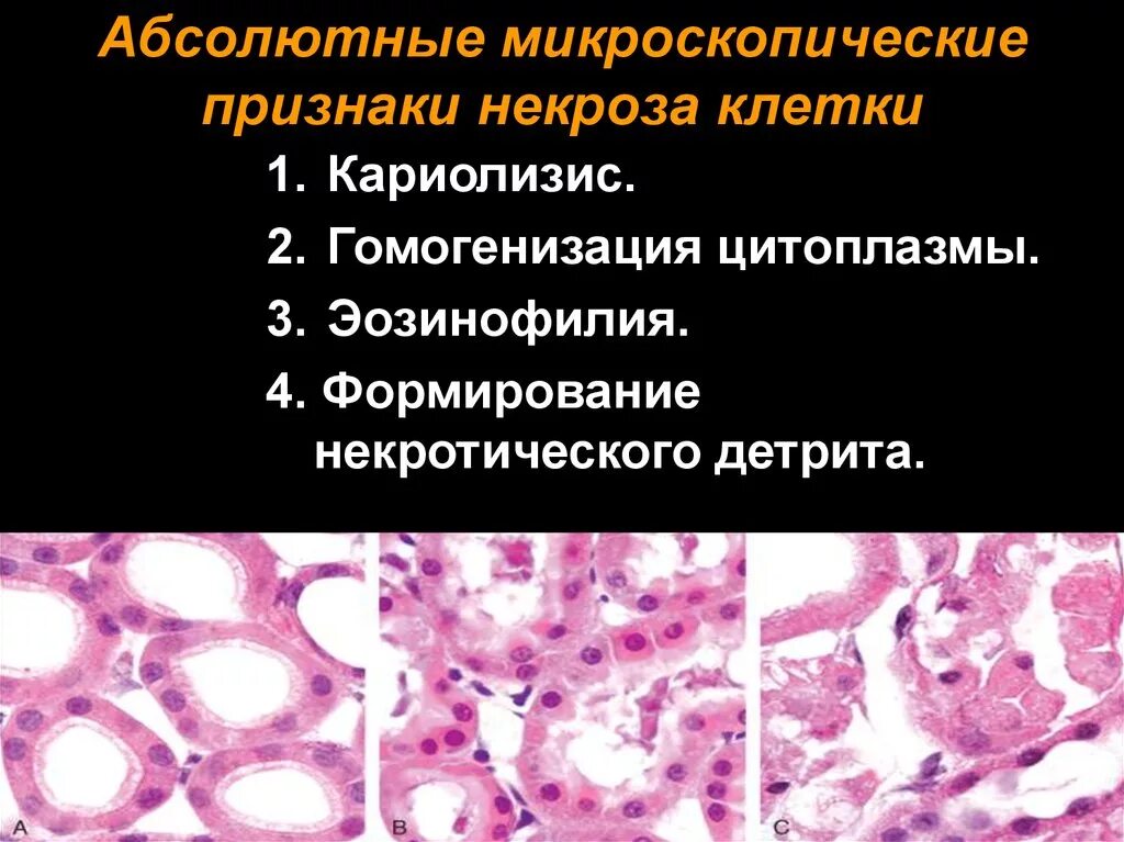 Микроскопические изменения в клетках. Кариорексис кариолизис. Апоптоз кариорексис. Кариопикноз кариорексис кариолизис некроз. Микроскопические изменения ядра клетки при некрозе.