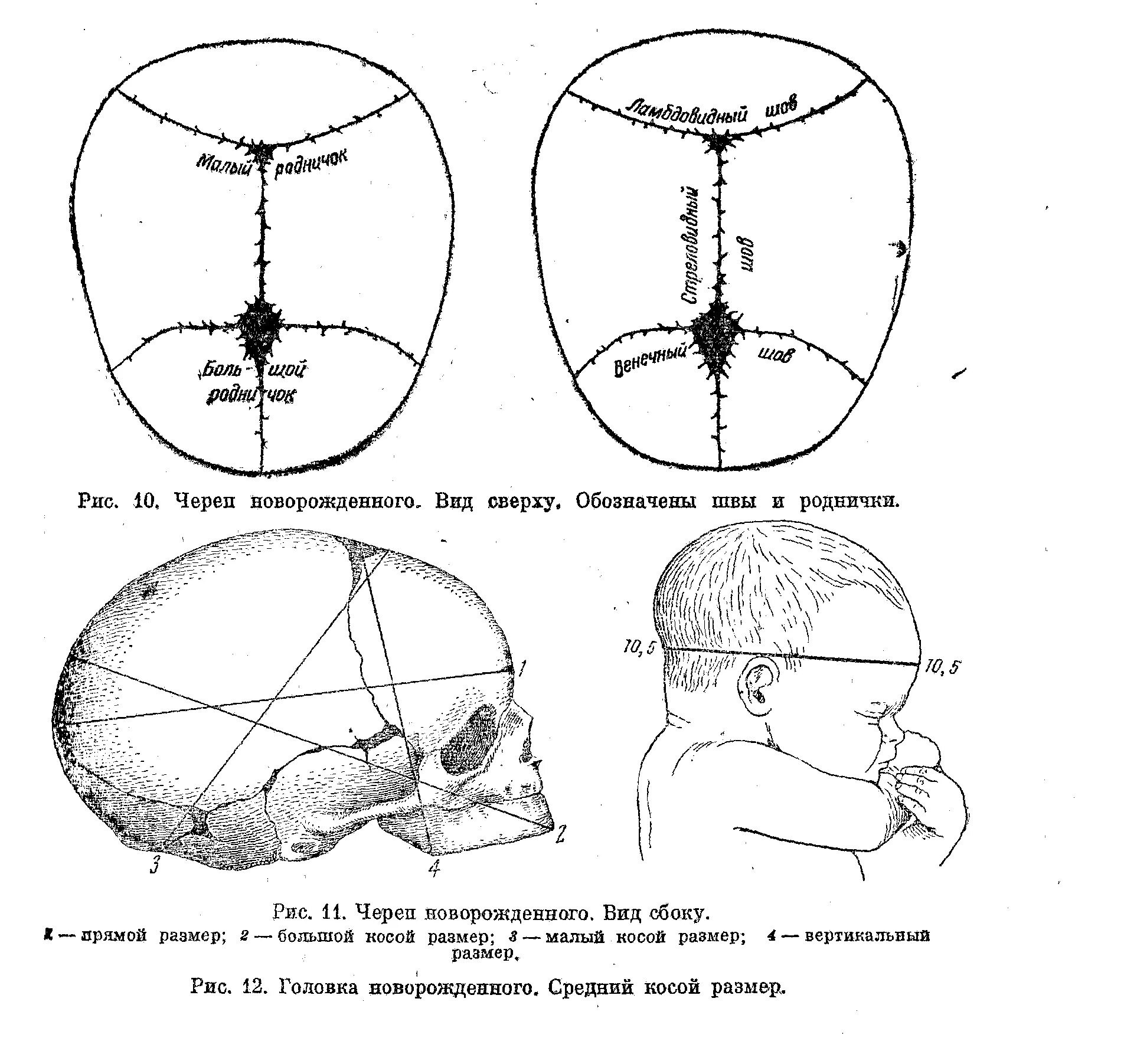 Швы большого родничка. Череп новорожденного роднички Размеры головки новорожденного. Швы роднички Размеры головки плода. Стреловидный шов черепа новорожденного норма. Череп новорожденного вид сбоку Размеры.