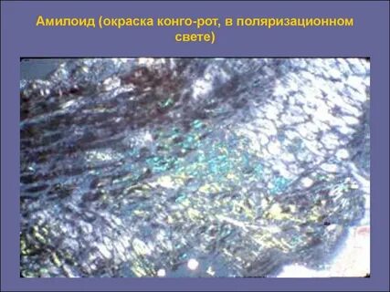 Амилоидоз окраска