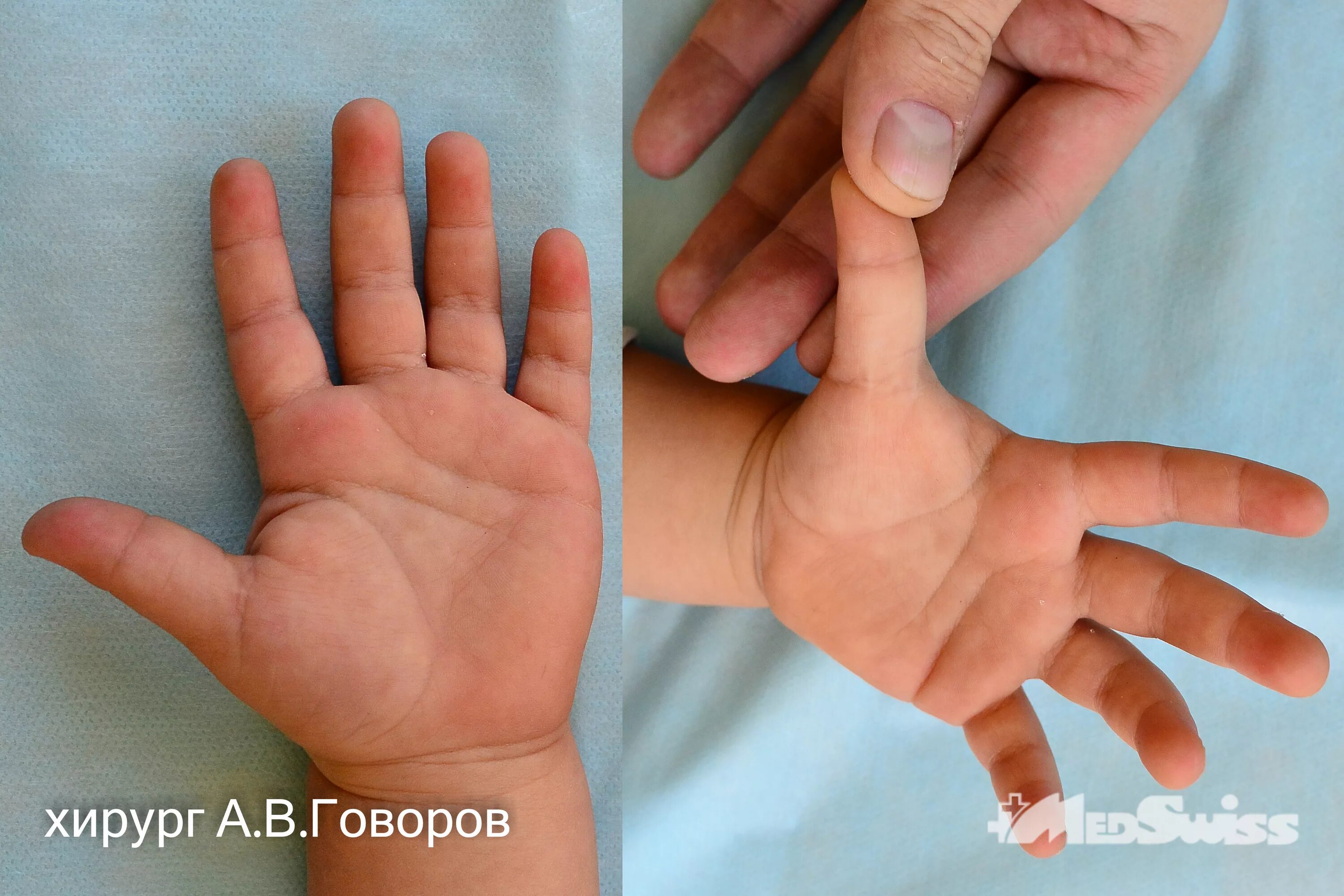 Болезнь нотта форум. Лигаментит пальца кисти. стенозирующий лигаментит пальца. стенозирующий лигаментит 1 па. стенозирующий лигаментит нотта.