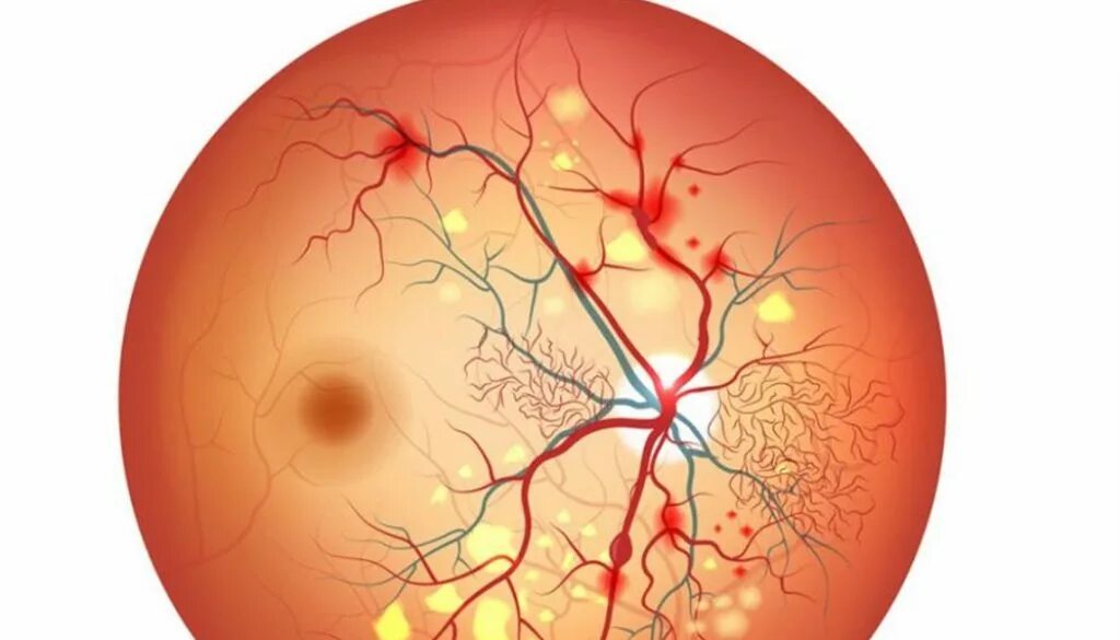 Ангиопатия сосудов сетчатки что это. Гипертоническая ангиопатия и ретинопатия. Диабетической гипертоническая ангиопатия. Диабетическая ретинопатия глазное дно.