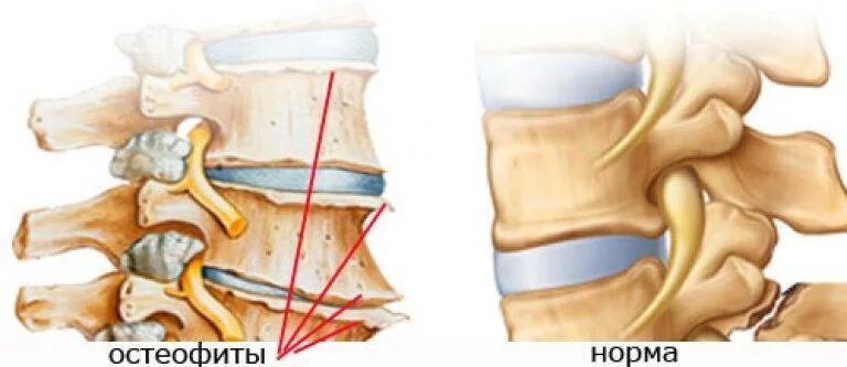 Спондилеза спондилоартроза поясничного отдела позвоночника. Остеофиты позвоночника крестцового отдела. Спондилоартроз поясничного отдела остеофиты. Спондилёз шейного отдела позвоночника что это такое. Остеофиты спондилез.