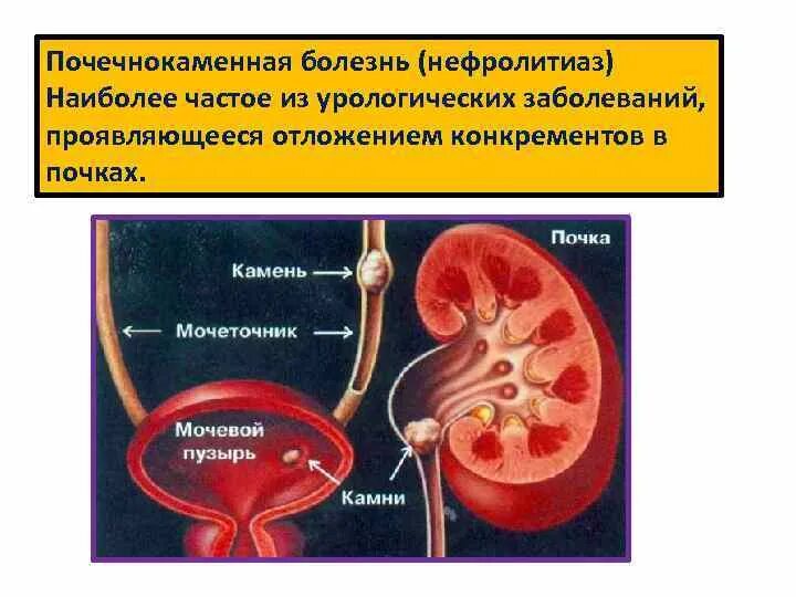 Мочевая колика. Почечнокаменная болезнь (нефролитиаз). Мочекаменная болезнь местные факторы. Почечнокаменная болезнь камнеобразование.