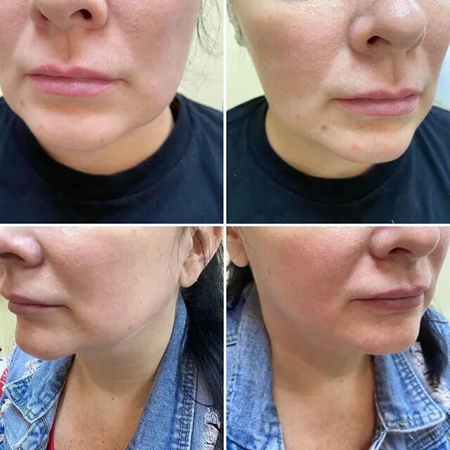 липолитик для лица. липолитики для лица лайт фит. липолитика для лица отзывы косметологов. липолитика для лица отзывы косметологов. липолитики для овала лица.