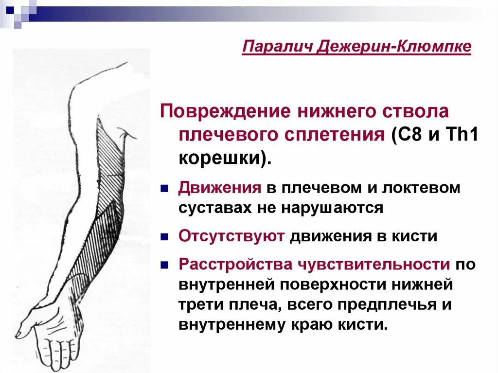 Почему руки парализовало. Нижний дистальный Тип акушерского пареза (Дежерин-Клюмпке). Паралич Дежерин Клюмпке клиника. Синдром поражения плечевого сплетения неврология. Симптом Дежерина Клюмпке.