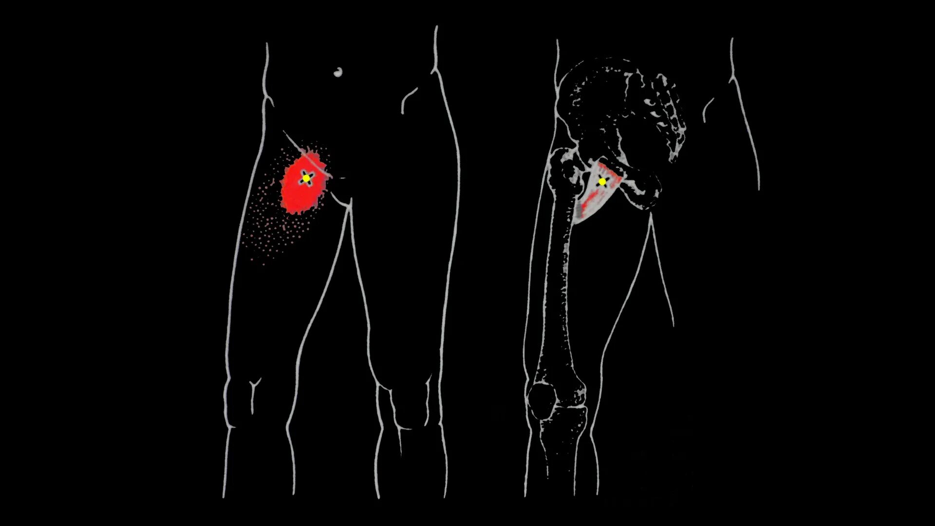 Поясница отдает в пах у мужчин. Триггерные точки грушевидной мышцы.